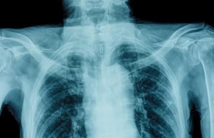 chest pain, personal injury, Connecticut personal injury attorney